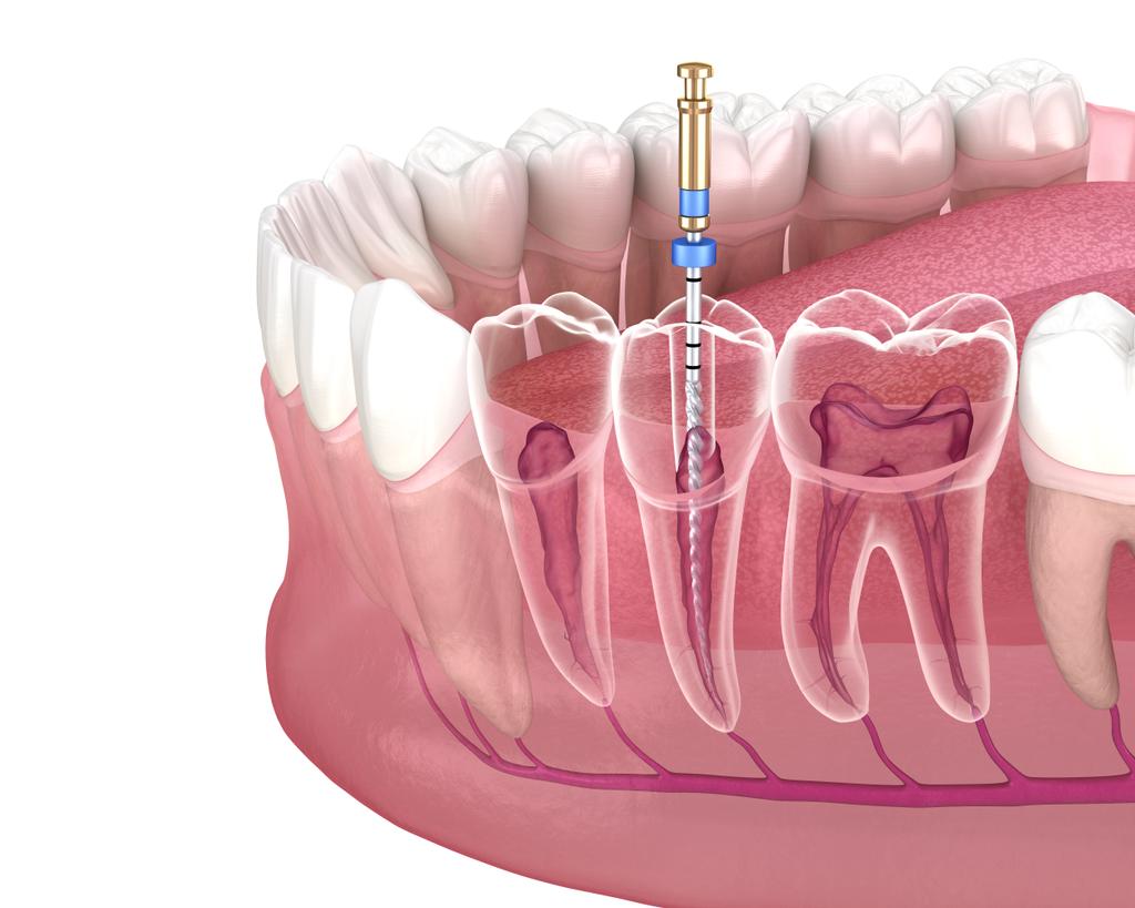 Root Canal Treatment Eliminate Toothache And Save Your Smile